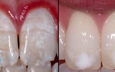 ¿COMO SABER SI NUESTROS DIENTES SUFREN EXCESO DE FLÚOR?